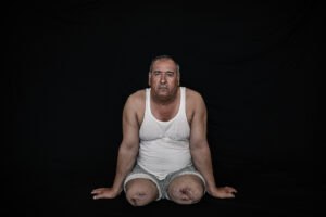 Brahim Ahmad Ebrahim Ghader was born in 1969, he is Peshmarga since 1993 and during this time two-time he got wounded which last time was fighting ISIS in May 2015 and he lost two-leg with and one eye and a lot of shrapnel in his body by the explosion from an IED in Daqoq Area near Kirkuk. According to Media reporters, more than 10,000 Peshmargah were wounded in the IS war.